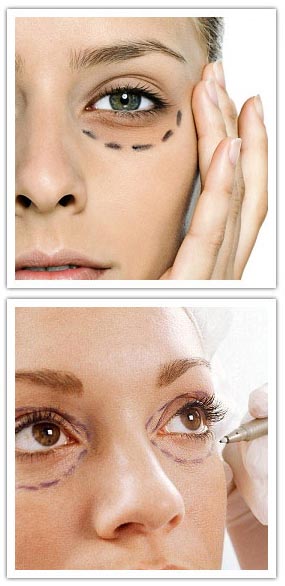 Dark Under-Eye Circles