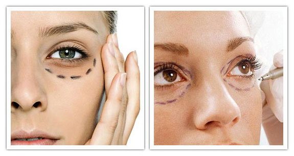 Dark Under-Eye Circles